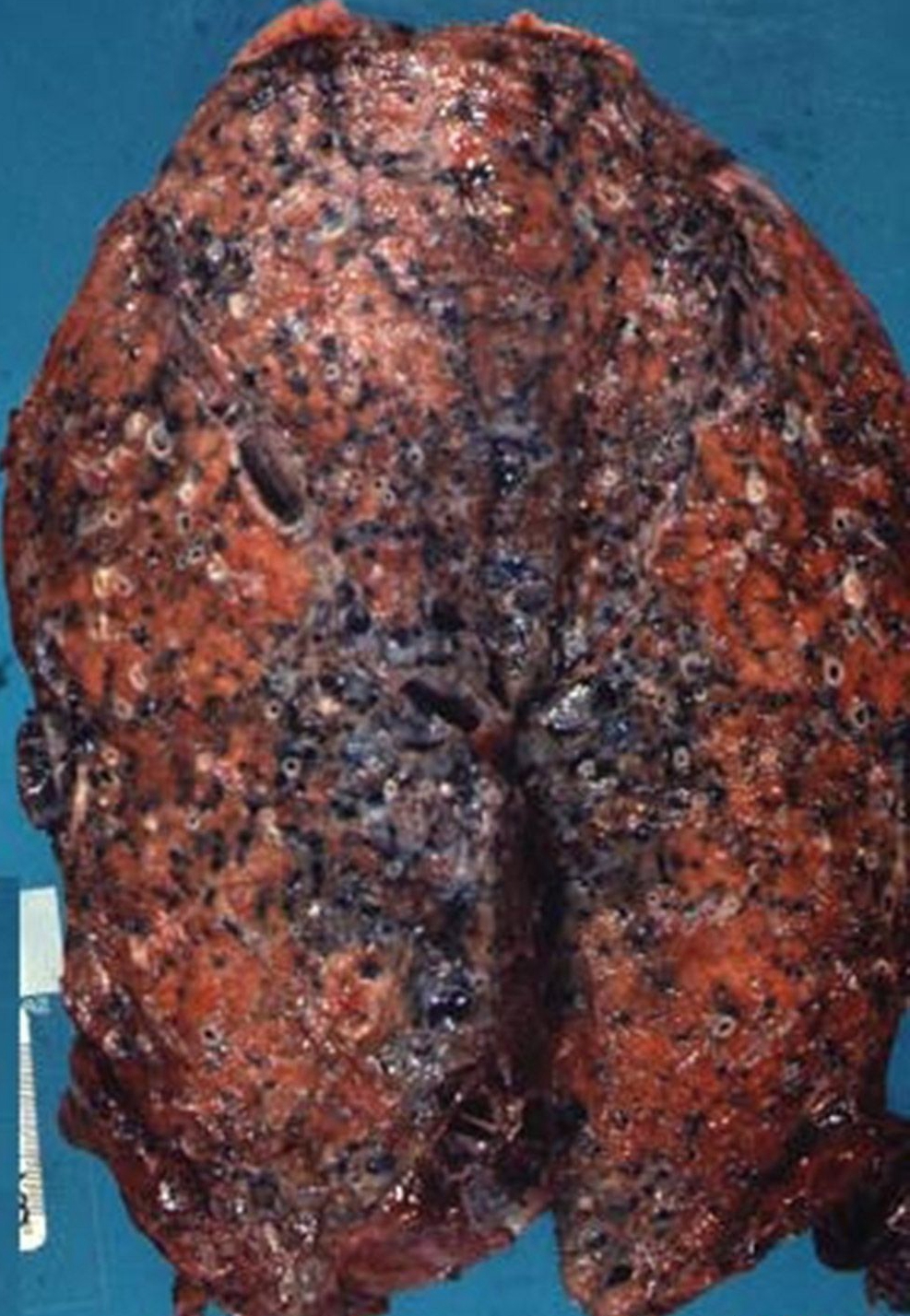 ＿重度肺纖維化的晚期