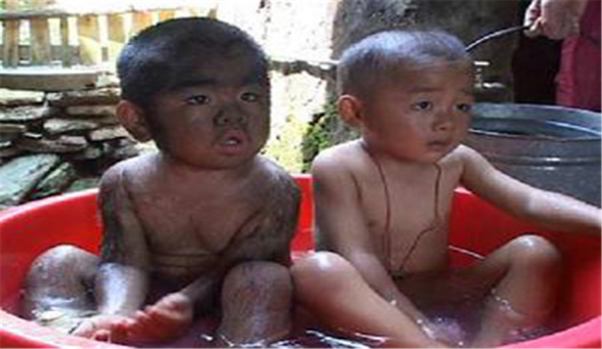 雙胞胎其中一個多毛症