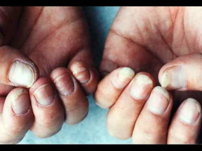 指甲部位皮膚念珠菌病