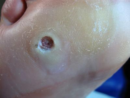 腳底蹠疣早期