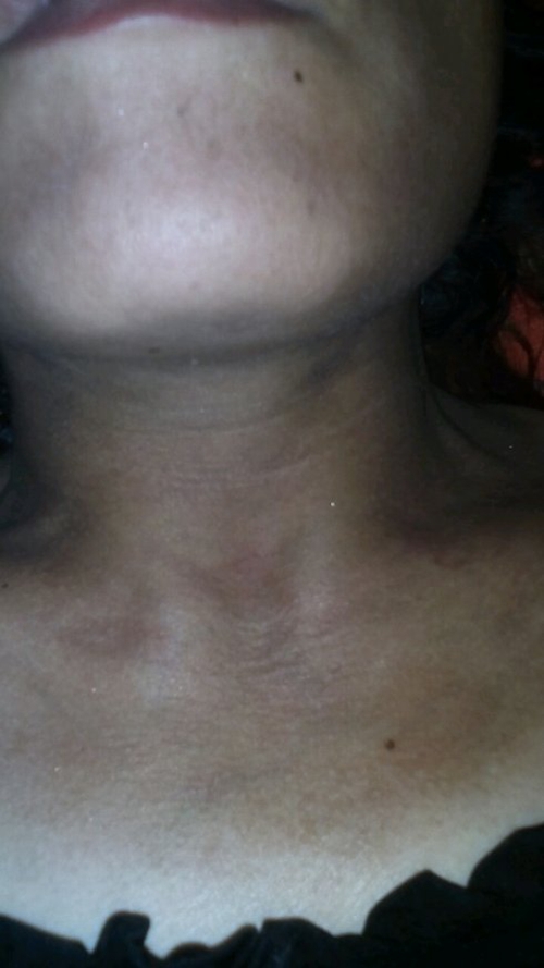 頸部的皮膚黑變病