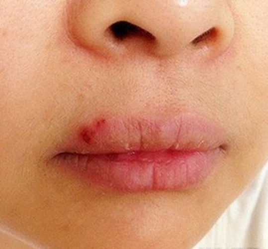 顏面口唇皰疹發癢