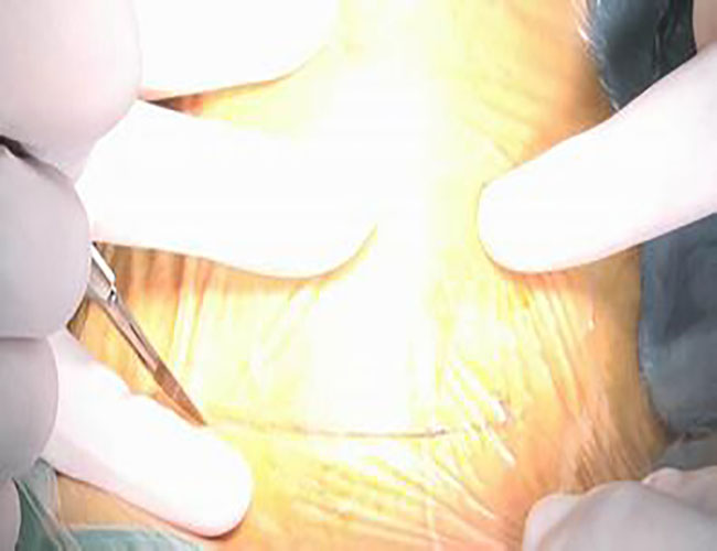 峽部甲狀腺瘤的手術