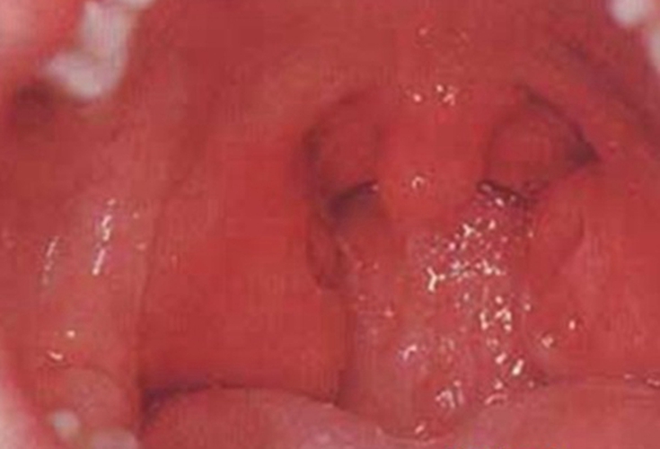 嚴重急性咽炎的