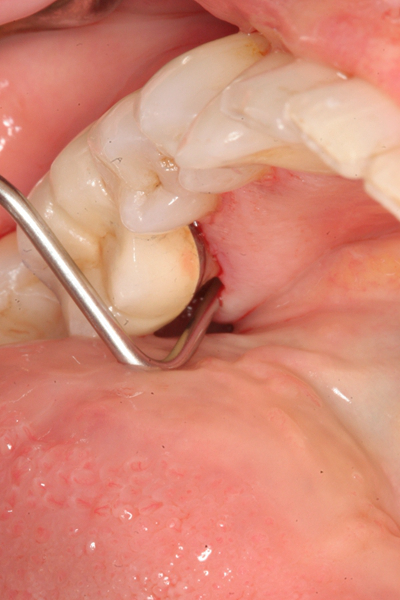 牙齦炎和牙周炎