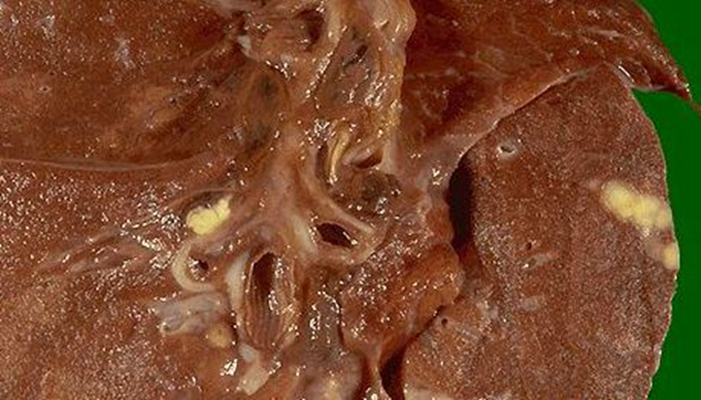 空洞型肺結核能活多久 (45) 