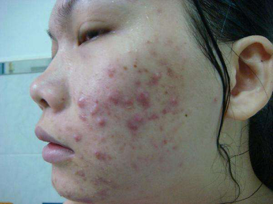 血熱的症狀痘痘