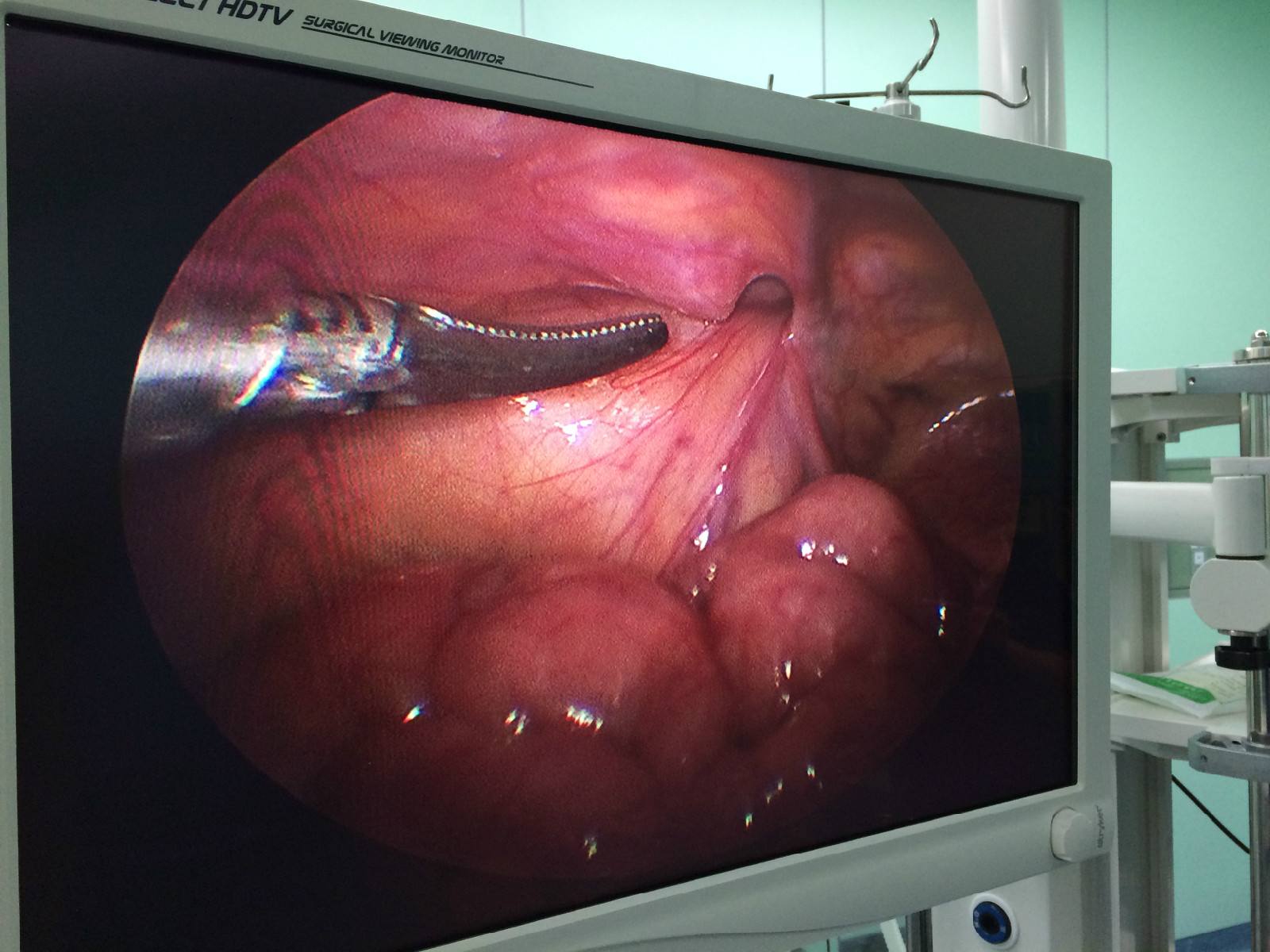 小兒鞘膜積液 (49) 