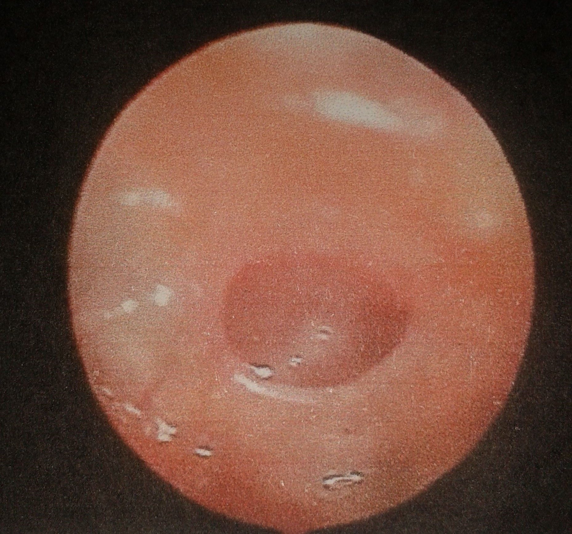 藥物治療的鼓膜穿孔