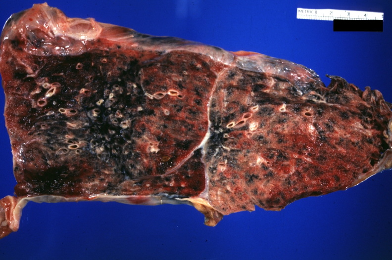 ＿左下肺肺纖維化病灶