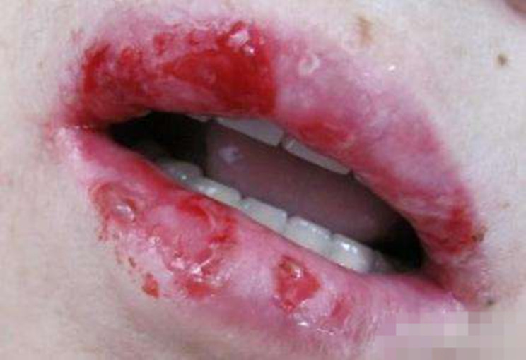 維生素A 扁平苔蘚 