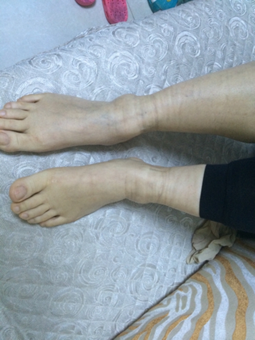 老人肺腺癌腹水腳腫