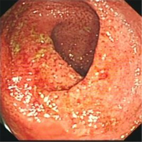 輕微潰瘍性結腸炎