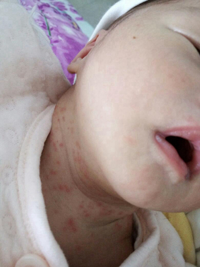 新生兒胎毒的症狀