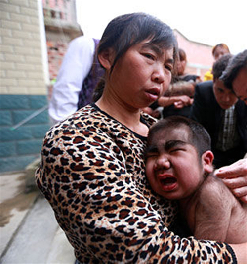 先天性遺傳多毛症