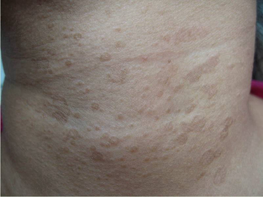 淋病的症狀 (52) 