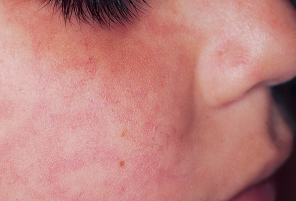 小兒猩紅熱症狀