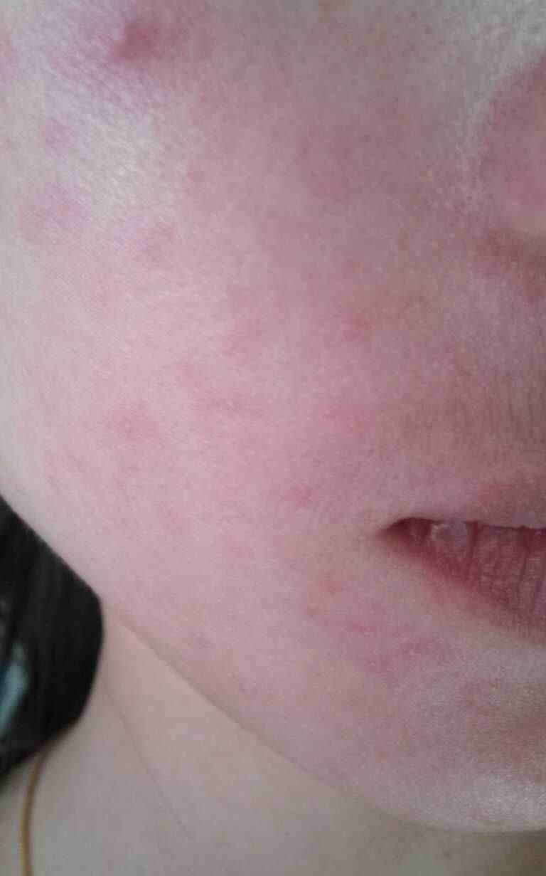 臉步日光性皮炎