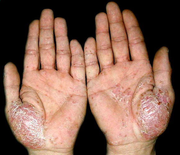 手部掌趾大皰性皮膚病