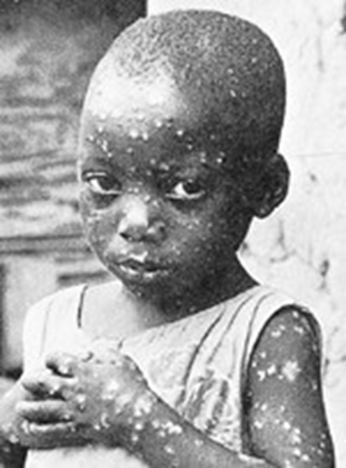 小孩患天花有救嗎