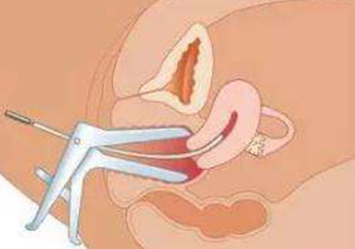 陰唇肥大事例圖 