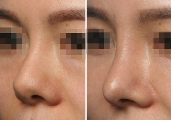 鼻子整形 (8) 