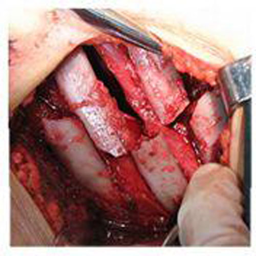 嚴重的肋骨骨折