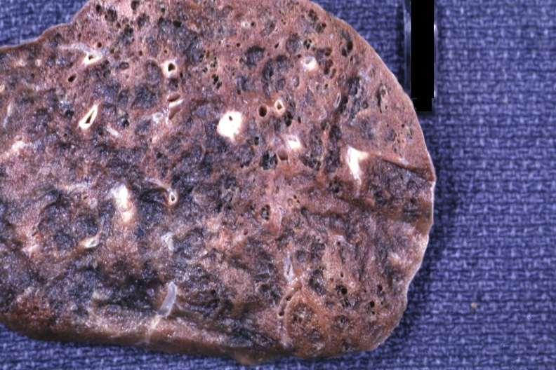 ＿硬皮病肺纖維化