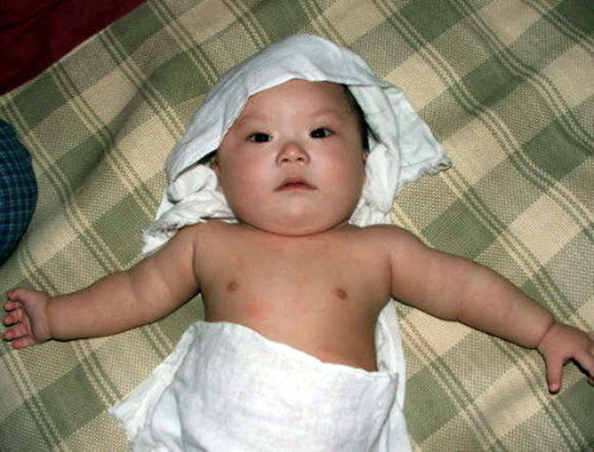 嬰兒唐氏綜合症