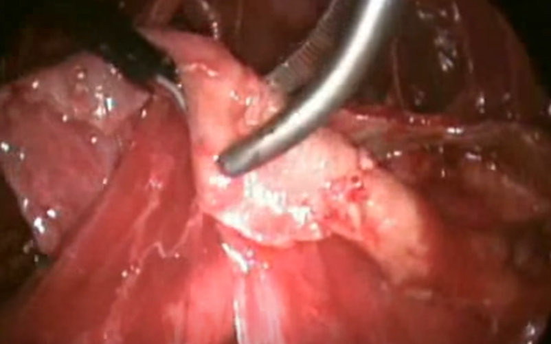 結核性胸膜炎胸腔積液的