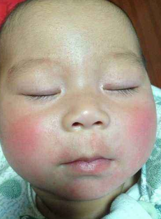 臉上皮膚過敏症狀