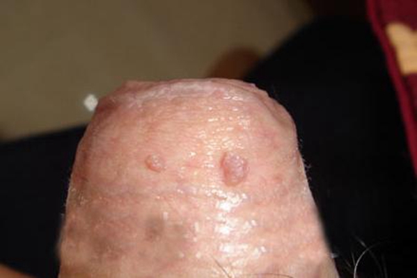 黴菌性龜頭炎 (42) 