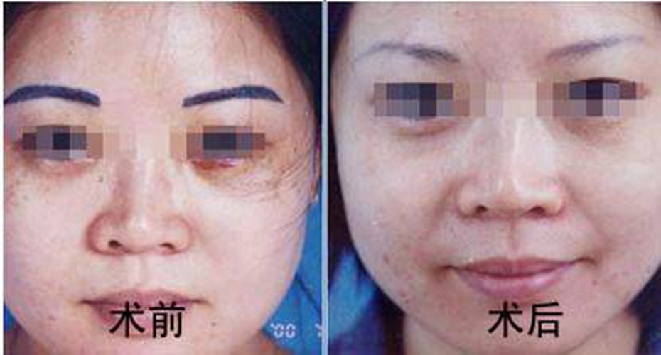 眼角下的老年斑手術前後