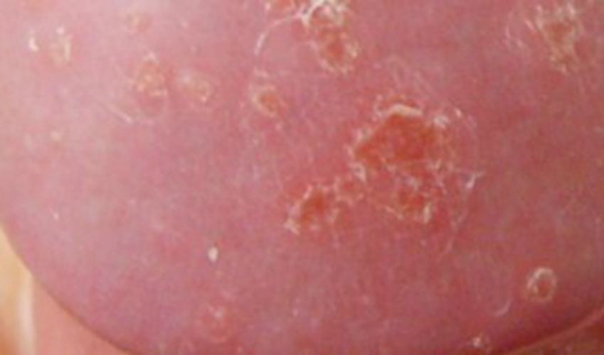 包皮龜頭炎種類