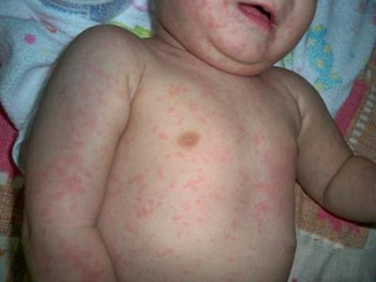 嬰兒蕁麻疹 (36) 