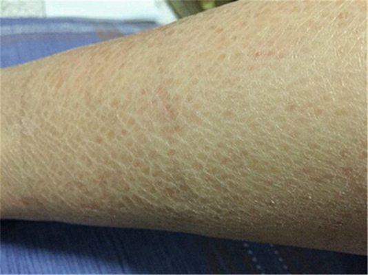 小腿皮膚像魚鱗 (46) 