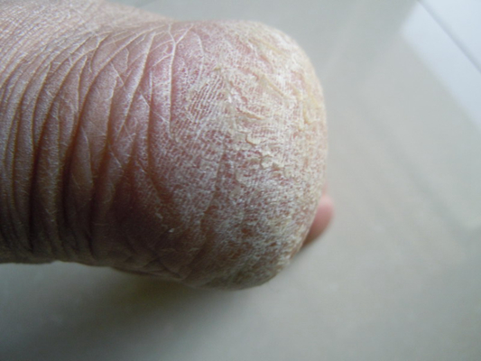 腳底乾裂 (37) 