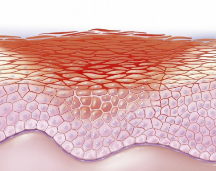 皮膚澱粉樣變 (56) 