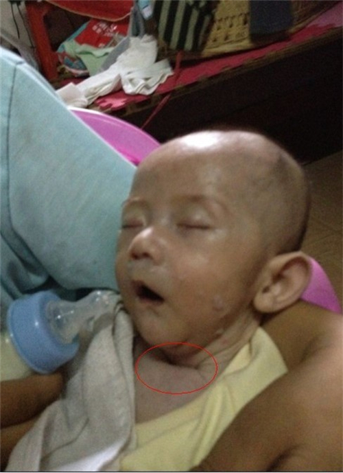 先天性喉喘鳴症狀