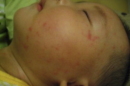 小兒急疹的症狀 (48) 