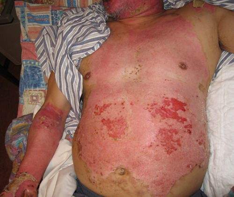 深二度燒傷 (53) 