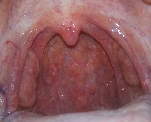 喉部淋巴濾泡增生 (7) 