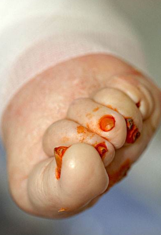 脈管炎早期症狀