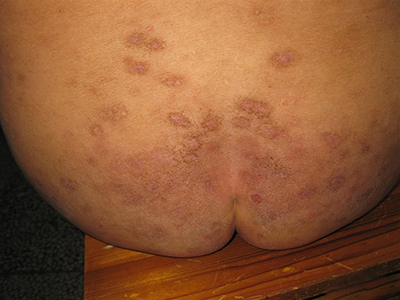 結節性癢疹 (47) 