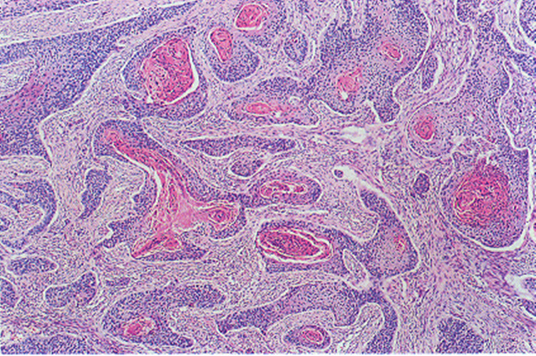 顯微鏡下惡性喉腫瘤