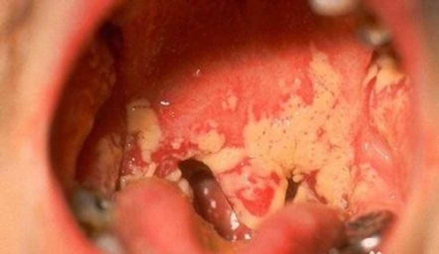 嚴重的內部的淋巴結前期口腔發炎