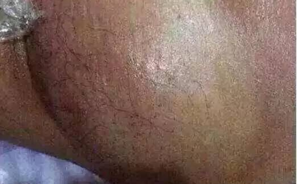 女性腋下淋巴癌早期症狀的