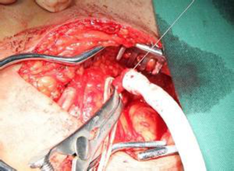 煙霧病早期症狀