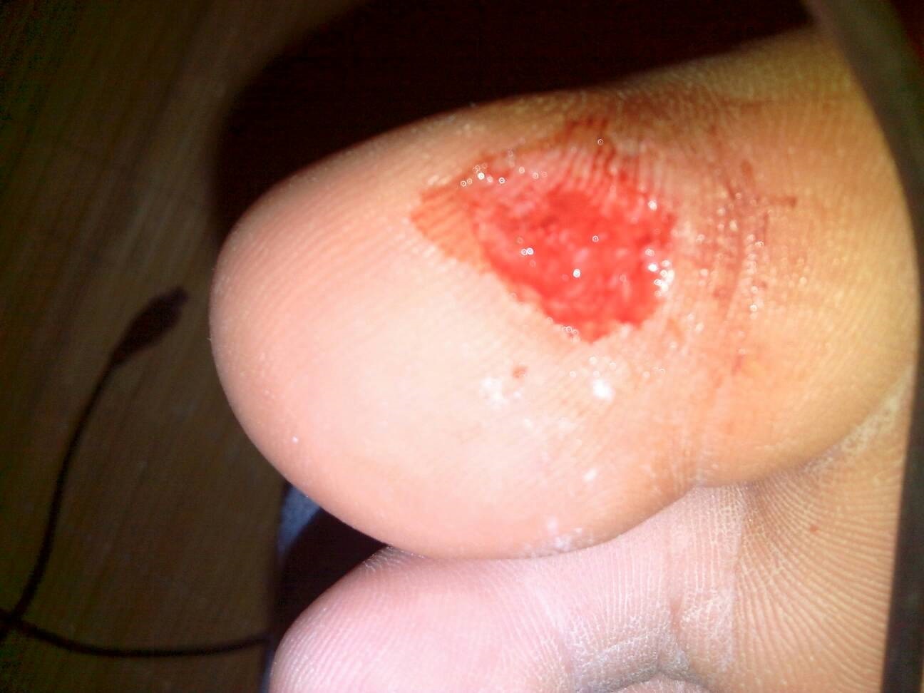 傷口淺而廣的破傷風傷口