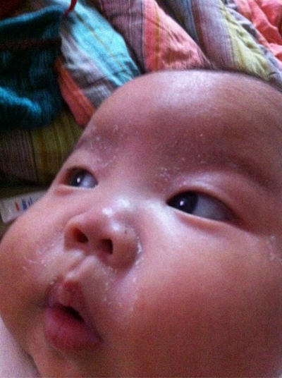 急性皮炎的症狀